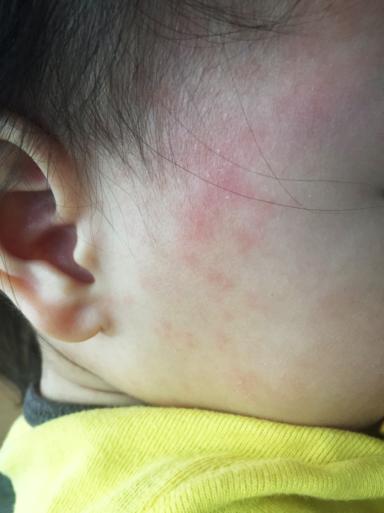 roseola fever rash toddler singapore 1