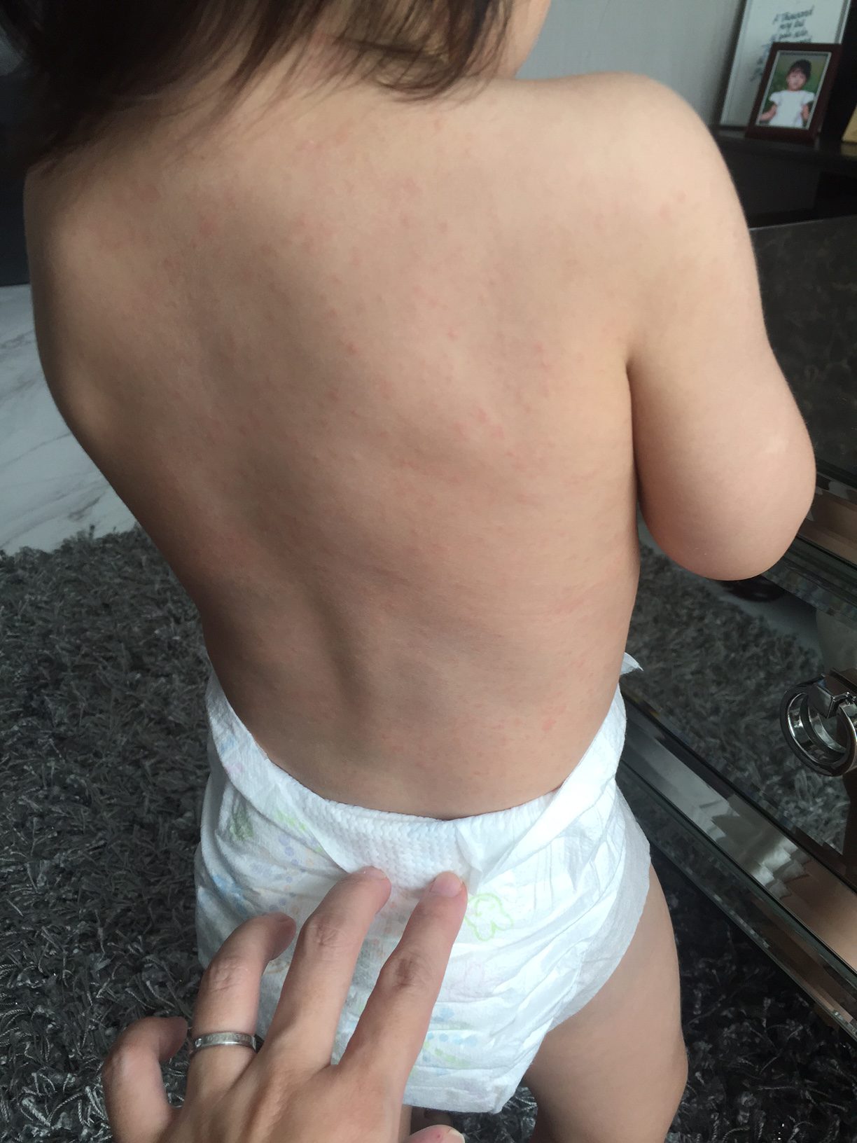 roseola fever rash toddler singapore 1