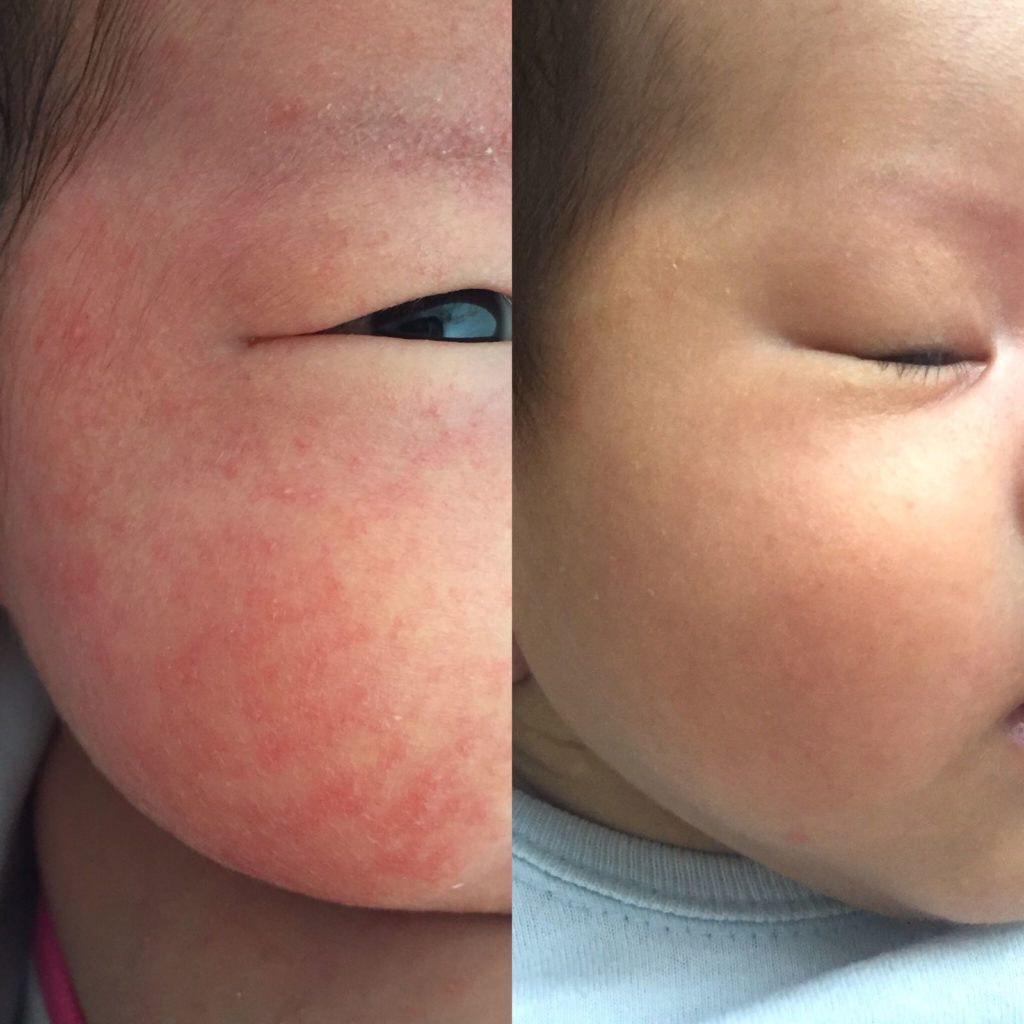 organic skin care for baby eczema singapore