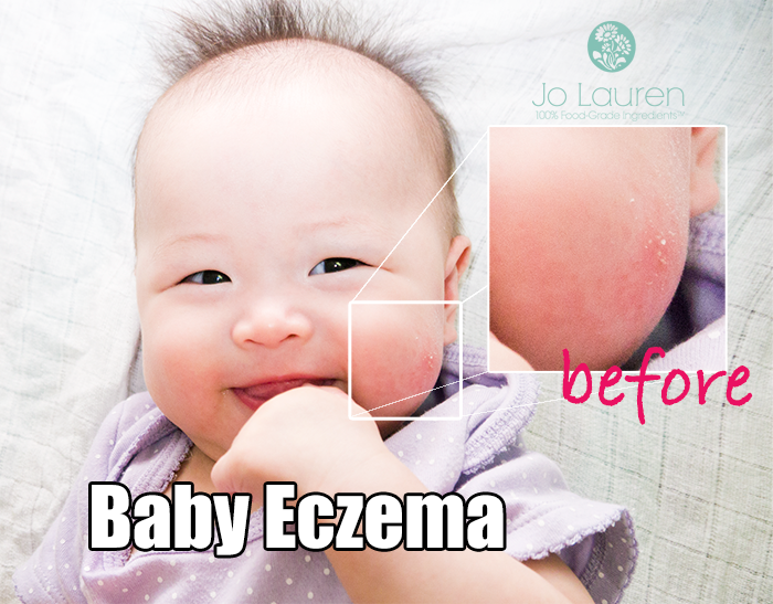 baby eczema singapore before and after