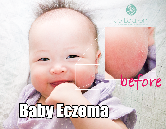 Baby Eczema Singapore Organic Skin Care By Jo Lauren Baby Eczema Singapore Organic Skin Care By Jo Lauren