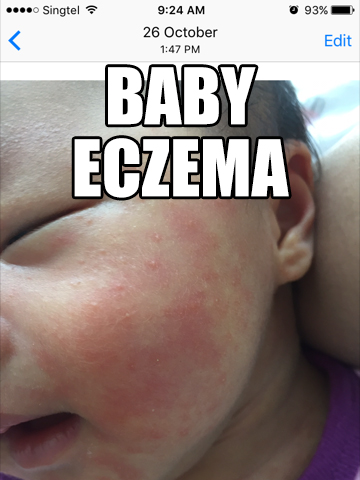 natural treatment for baby eczema rash