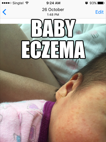 婴儿湿疹治疗法