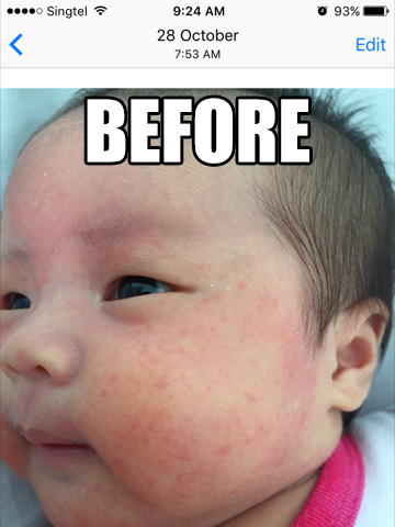 before and after baby rash