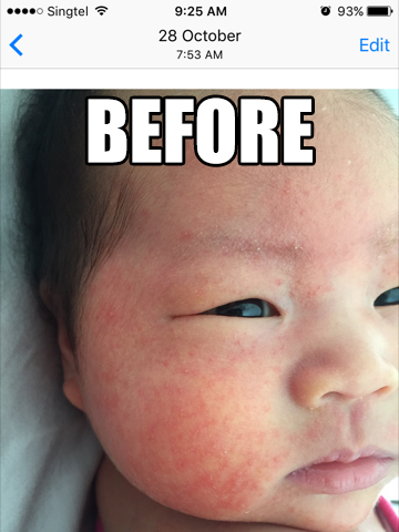 natural treatment for baby eczema rash