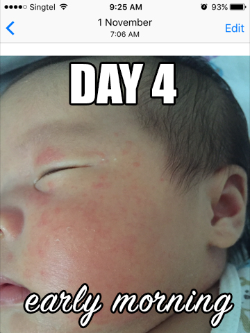 婴儿湿疹天然治疗法