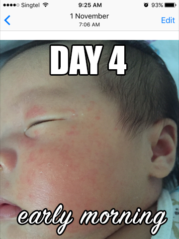 natural treatment for baby eczema rash