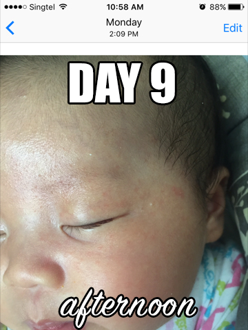 婴儿湿疹天然治疗法