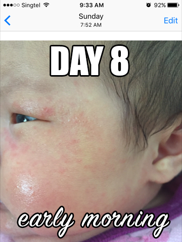 natural treatment for baby eczema rash