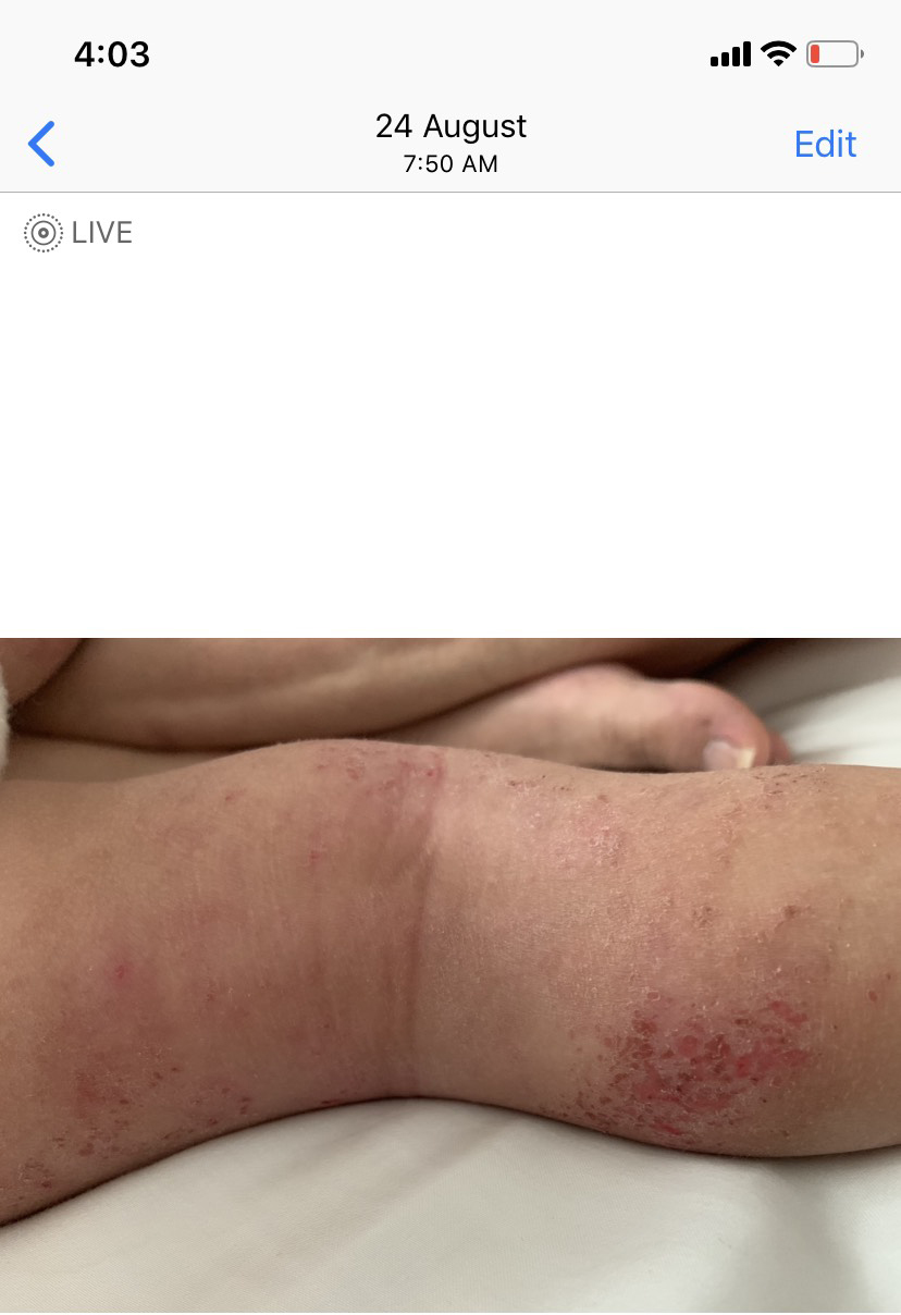 baby eczema treatment