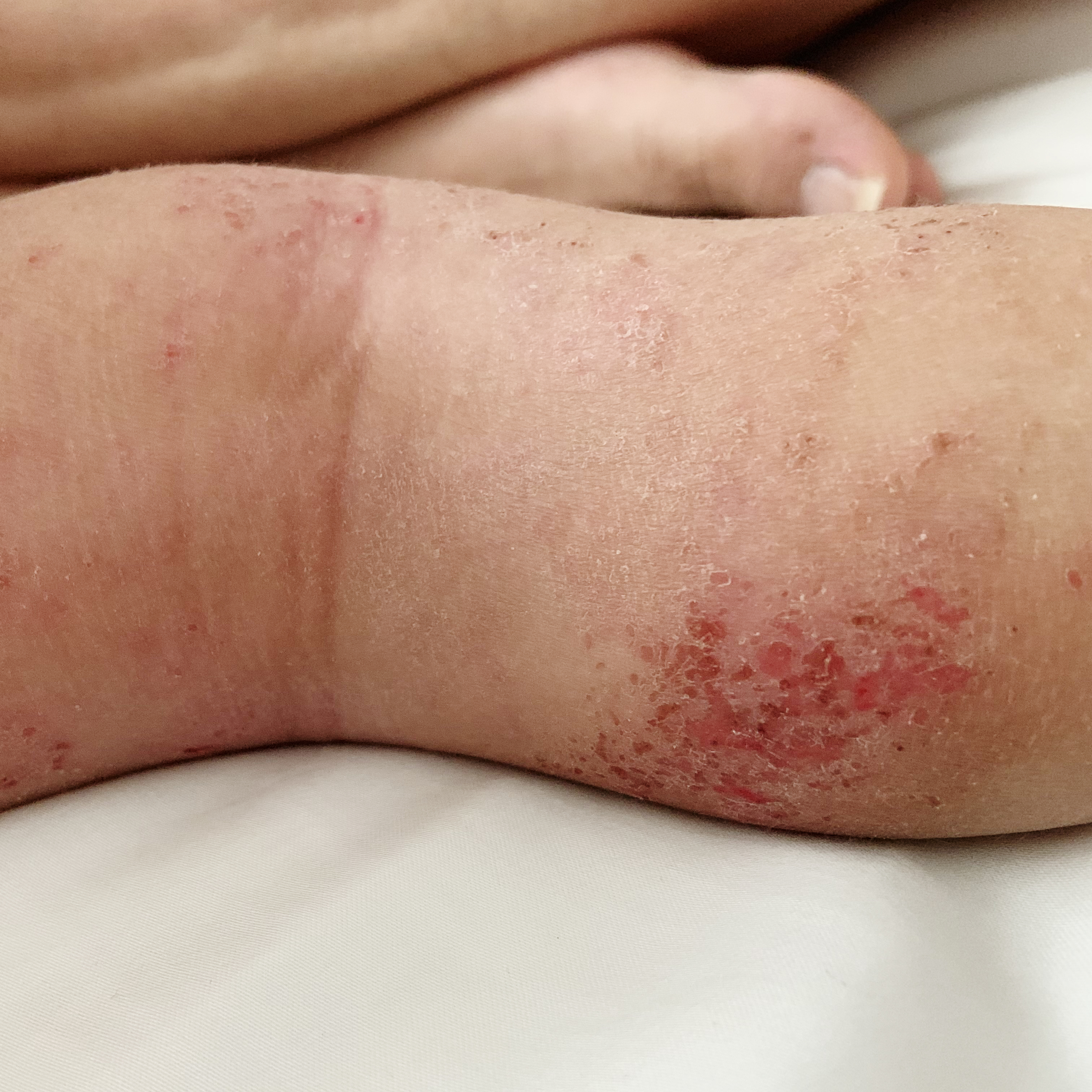 baby eczema on leg